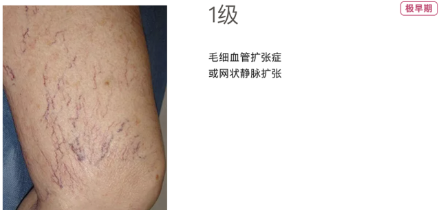 毛细血管扩张或网状静脉扩张1级极早期在实际工作中,医生常常做了简化