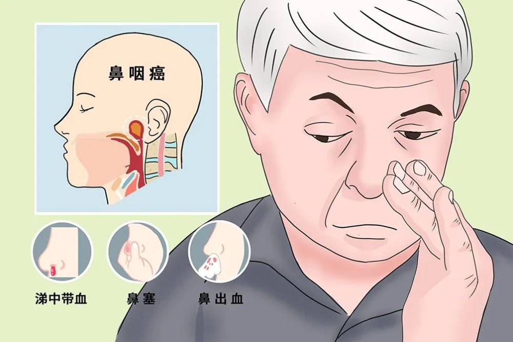 鼻咽癌放疗副反应的预防及护理
