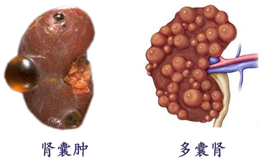 对于囊肿发生在其他器官,例如多囊肝和脑动脉瘤等的治疗:多囊肝发展