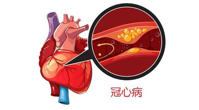 什么是冠心病冠心病的症状有哪些常见的治疗方式是什么