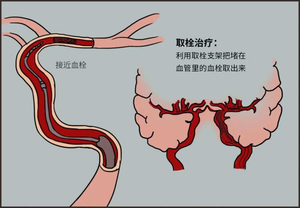 科普大赛作品展9号作品神奇的取栓治疗