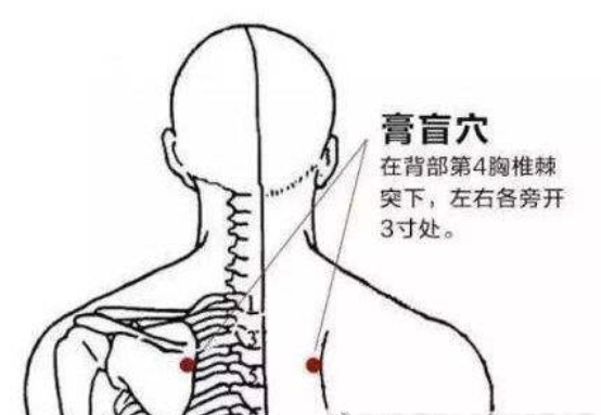 膏肓穴除了艾灸还可以挑治急救休克
