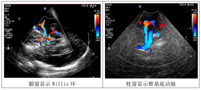 经颅彩色多普勒超声(tccd)是近年来发展的一种无创可视化脑血管超声