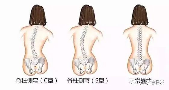 小儿推拿杨晓儿童脊柱侧弯危害大要早预防早发现早治疗