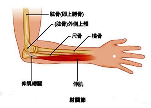 网球肘是肘部关节常见的伤病,主要因前臂伸肌长期反复的牵拉,肌肉肌腱