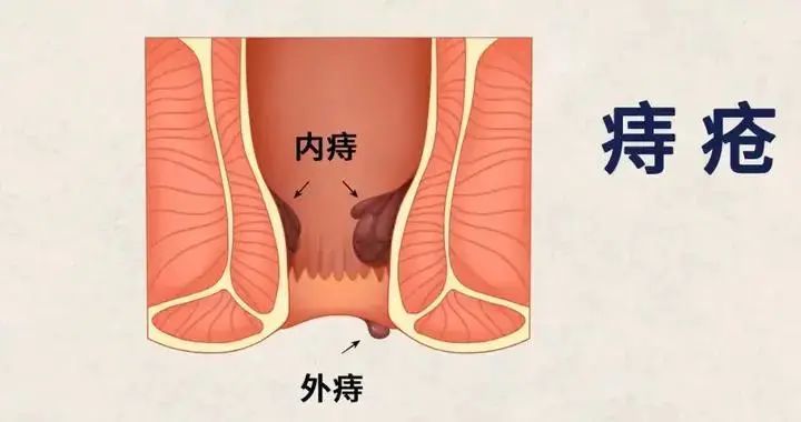 01 痔疮不是疮,是一种静脉病变缩短入厕时间是预防痔疮的关键