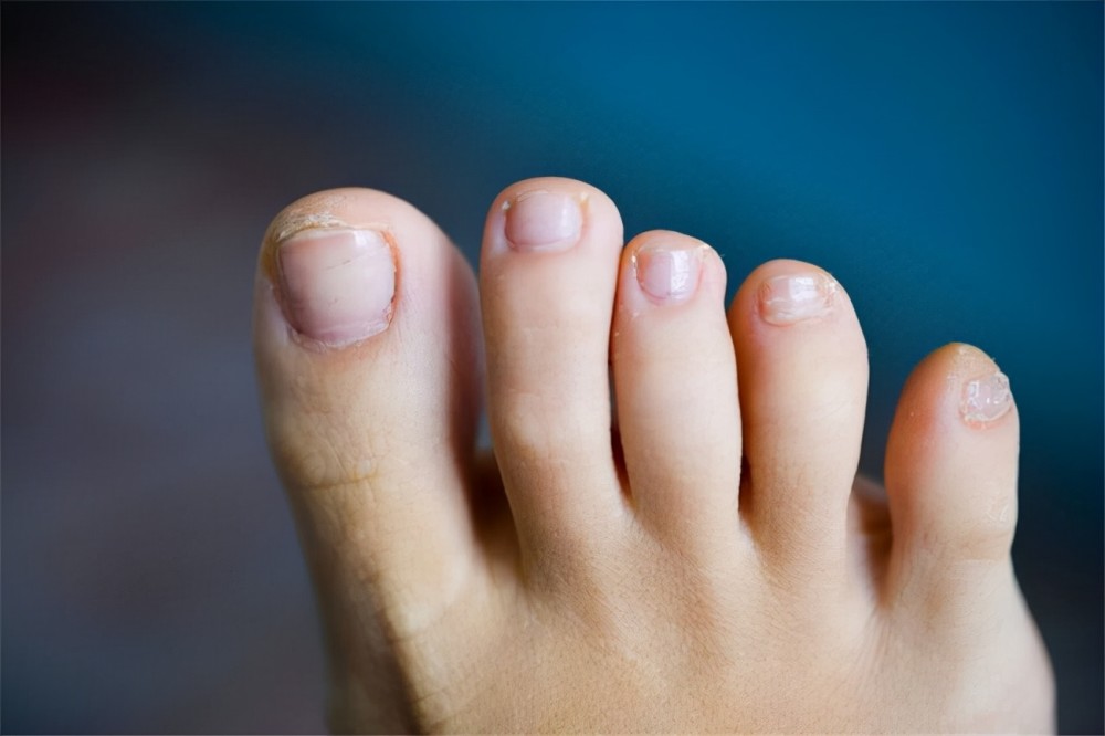 实际上,小脚趾指甲长成两瓣的现象,在医学上被称之为"瓣状甲".