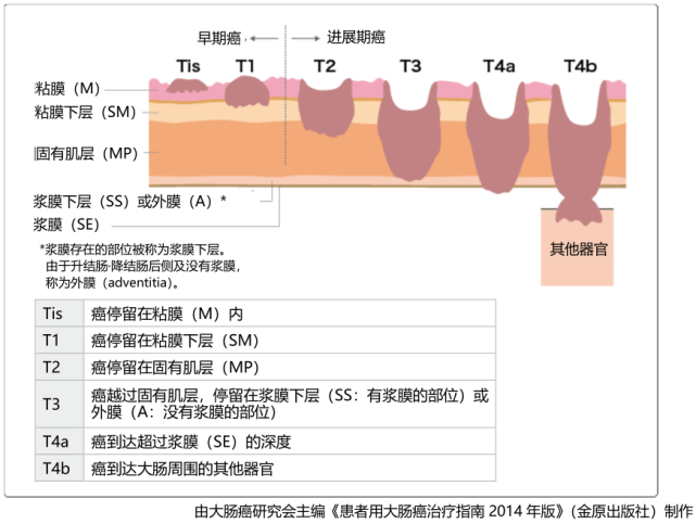 jmt日本出国就医|大肠癌(结肠癌·直肠癌)的疾病分期和治疗选择详解