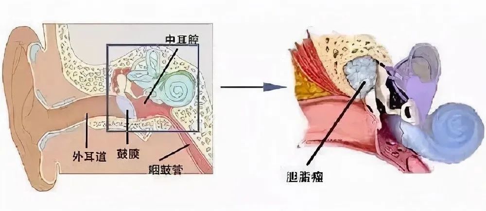 谁说耳鼻喉疾病不会夺命中耳胆脂瘤就是其中一个大雷