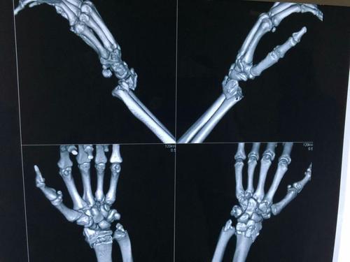 桡骨远端骨折多是外力间接导致,此病按照骨折类型主要分为三种