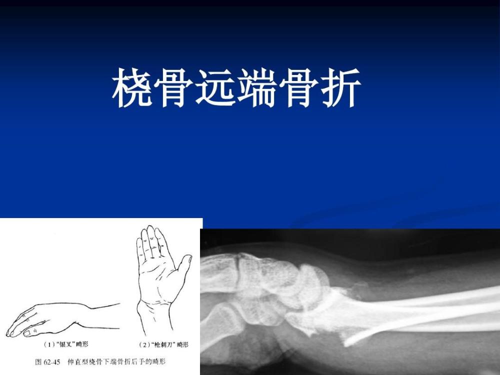 桡骨远端骨折多是外力间接导致,此病按照骨折类型主要分为三种