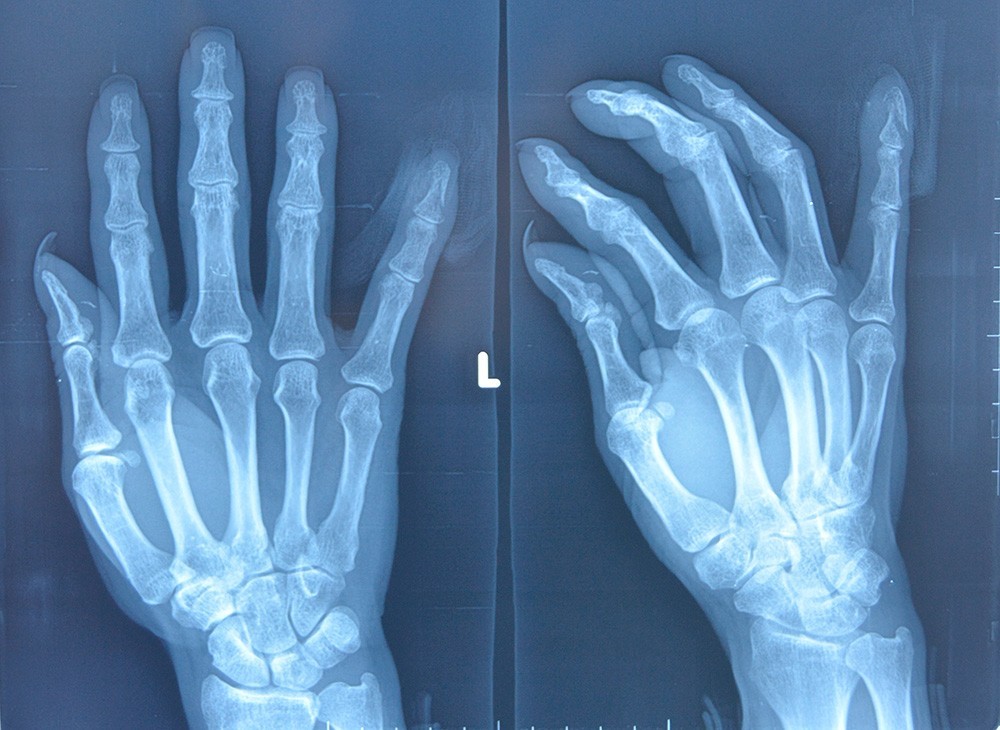 手掌,手背或多指损伤可能是指腕部神经阻滞;较大的伤口一般是在手臂