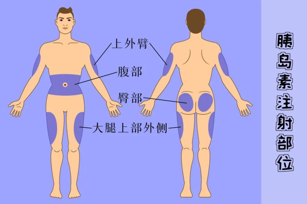 根据吸收速度的不同,不同种类的胰岛素首选的注射部位应不同;指南推荐