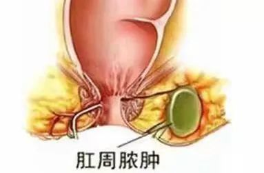 由于臀部,会阴部,肛门周围皮脂腺发达,出汗多,容易长火疖子.