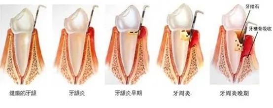 溢脓,咀嚼无力,牙周袋形成以及牙肉萎缩等现象;1,在牙周病初期时会