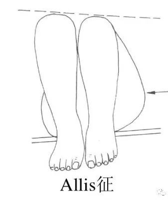 37mcmurray test患者仰卧位,检查者一手按住患膝,一手握住踝部,将膝