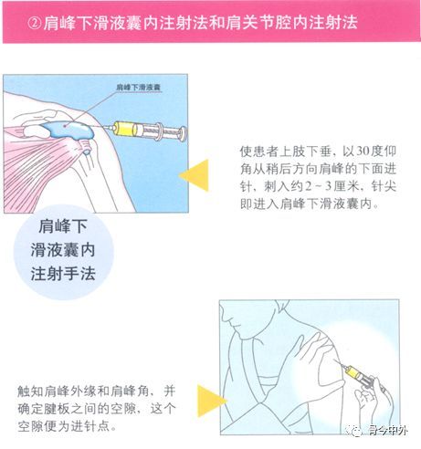 【骨科小技巧】肩关节穿刺术!