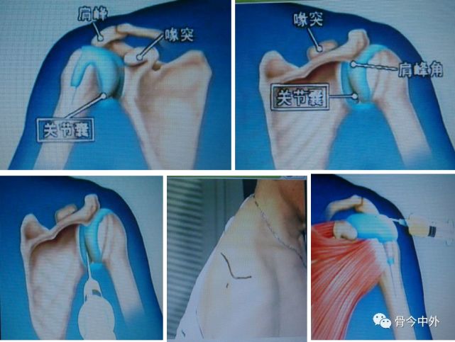 【骨科小技巧】肩关节穿刺术!