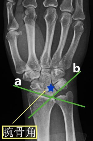 在腕关节平衡中,其腕骨本身形态,邻近关节面的形态(尤其是桡骨远端)