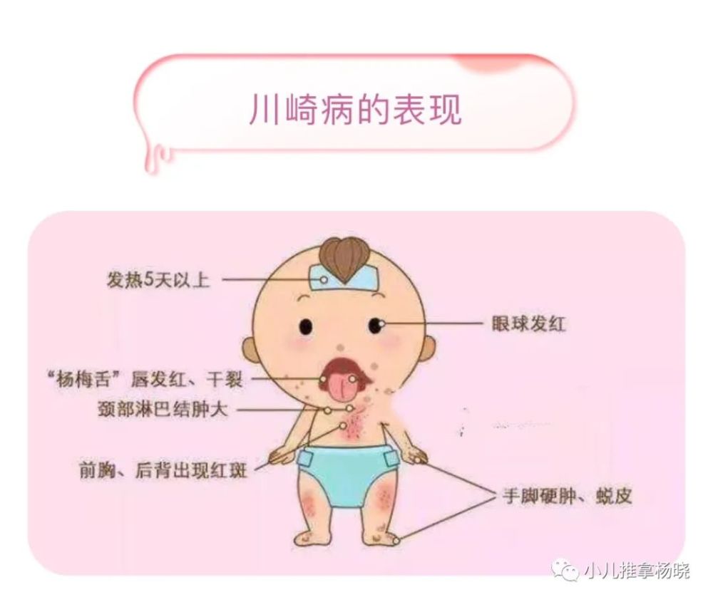 小儿推拿杨晓什么是小儿川崎病有哪些症状如何诊断和护理