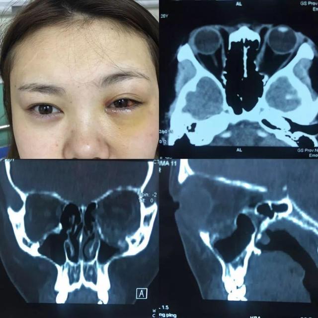 眶底骨折较弱,主要由上颌窦上壁的眶突所组成.