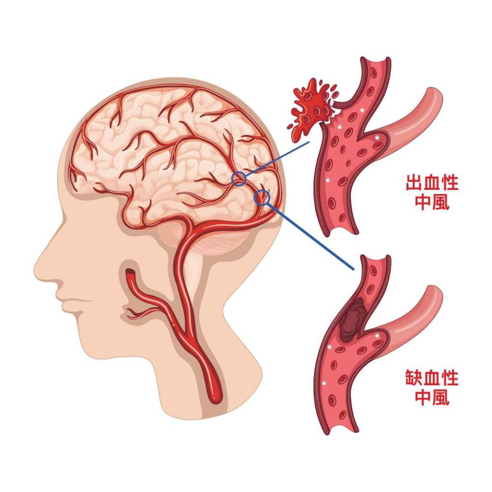 顾名思义,即脑动脉系统的缺血或出血所引起的脑卒中,其中缺血性脑中风