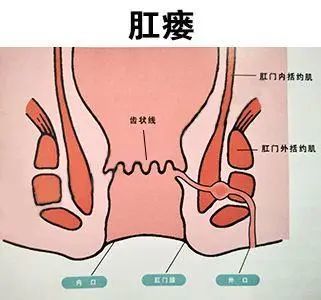 大量结缔组织的增生,变硬,使肛门肌肉失去原有的弹性,从而影响肛门