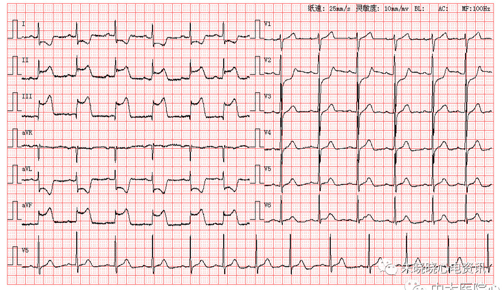 每日读图|第1545期 2:1房室传导阻滞 不完全性右束支传导阻滞
