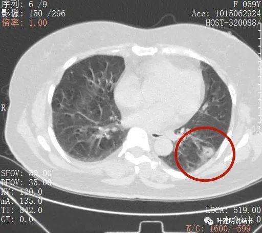 10.31):虽然是典型的肺癌,但看片子总