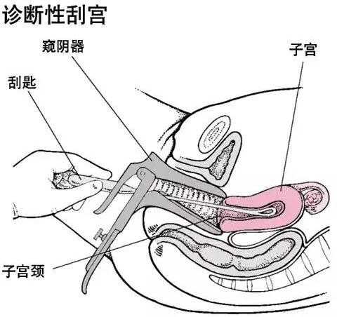 刮宫为刮取子宫内膜或宫腔内容物的手术.什么是刮宫? 刮宫分为哪几类?