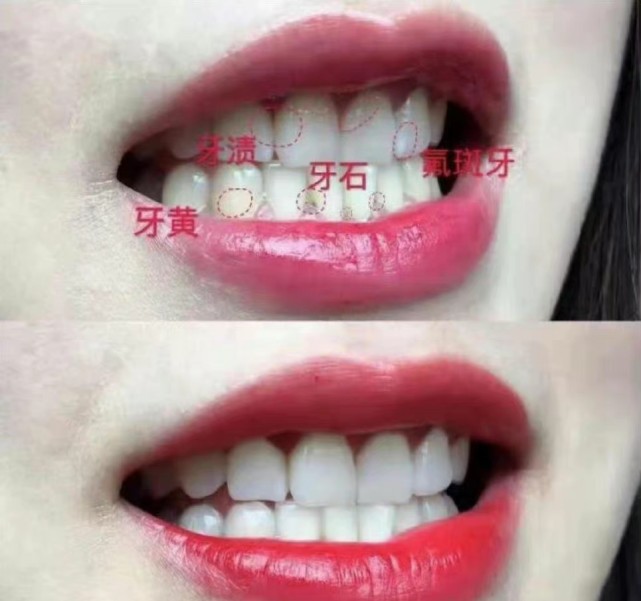 牙齿有多影响颜值?