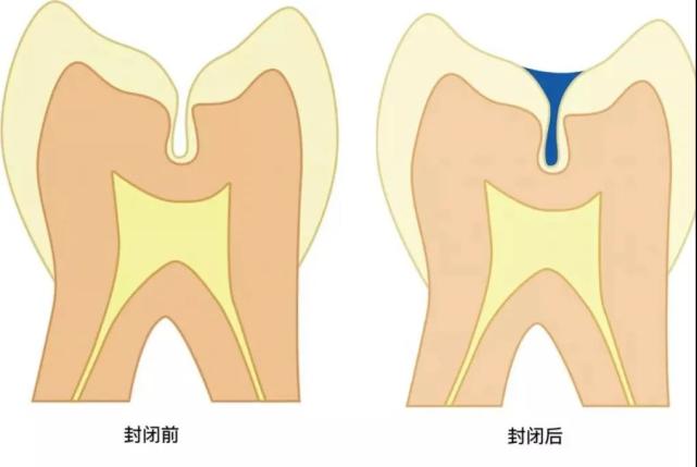 窝沟封闭到底封闭了个啥