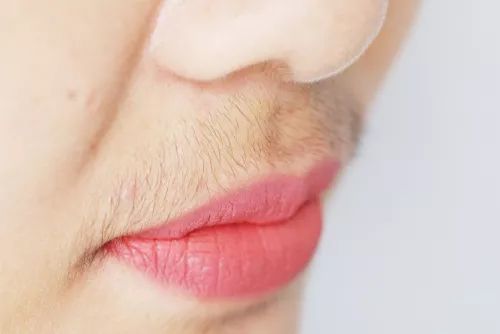 女性长胡子痤疮脱发可能是多囊卵巢综合征在作怪