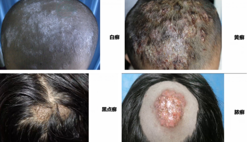 总结总之,头癣是指累及头发和头皮的皮肤癣菌感染,主要累及学龄前期
