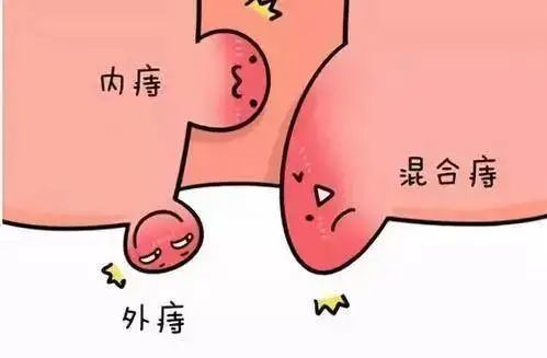 1,脱出形状不同一些病人将痔疮脱垂误认为是脱肛,可是经过检查后,才