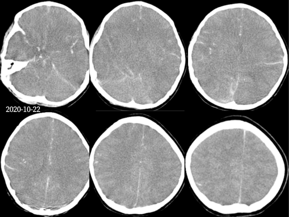 影像诊断:假性蛛网膜下腔出血(pseudo-subarachnoid hemorrhage,p