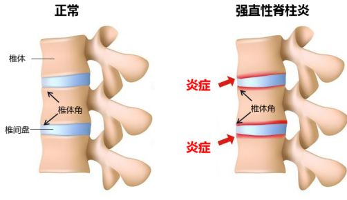 令周杰伦深受折磨的强直性脊柱炎,干细胞吹响攻克冲锋号!