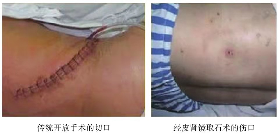 肾结石如何进行经皮肾镜取石术治疗