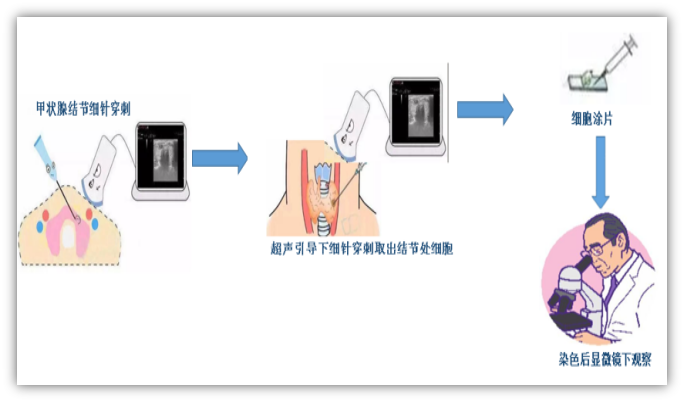 乳腺穿刺,浅表肿物穿刺,淋巴结穿刺等,都可以通过超声引导穿刺活检的