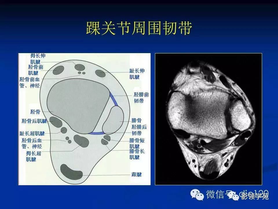 踝关节旋后损伤通常导致距腓前韧带,跟腓韧带以及前外侧关节囊撕裂
