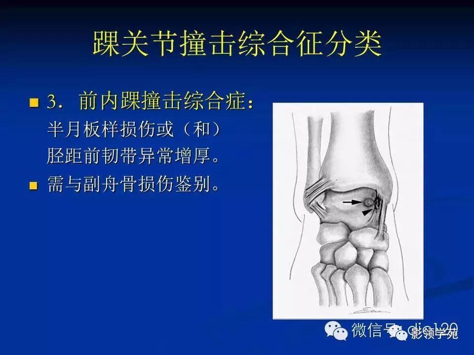 踝关节旋后损伤通常导致距腓前韧带,跟腓韧带以及前外侧关节囊撕裂