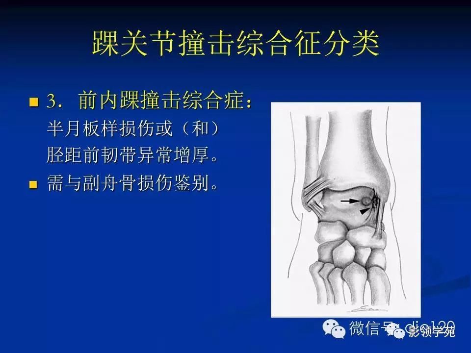 前外侧撞击综合症:踝关节旋后损伤通常导致距腓前韧带,跟腓韧带以及前