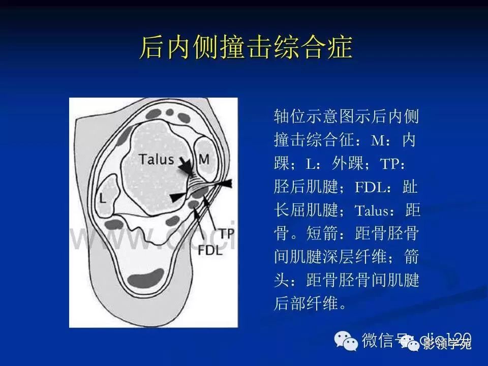 前外侧撞击综合症:踝关节旋后损伤通常导致距腓前韧带,跟腓韧带以及前