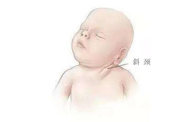今年31岁的小丽(化名)就是一名"先天性肌性斜颈"患者,因为从小生活在