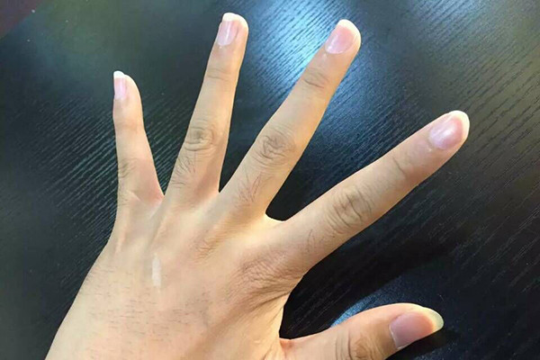 医生:看看你的中指,是否存在3种表现