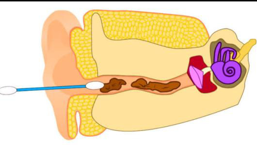 耳朵越掏越栓塞,会引发中耳炎?方法得当,无须