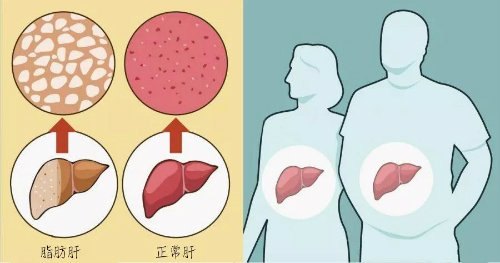 肝细胞内的脂                    引起了一个肝的脂肪变性,引起肝