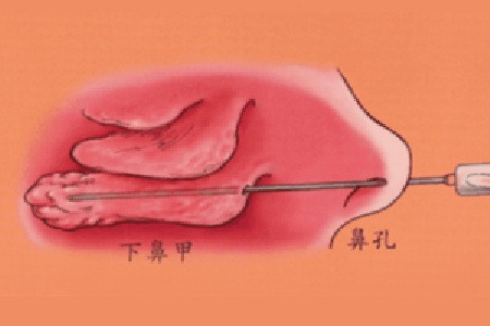 鼻甲肿大的预防措施