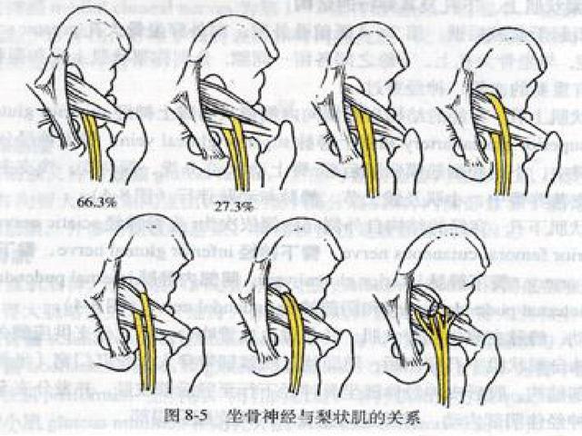 梨状肌综合征病因是什么患者的临床表现有些什么如何治疗