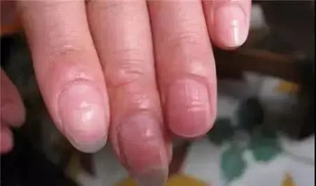 指甲表面出现多个小横沟1健康的指甲是红润坚韧的半透明弧形,看起来